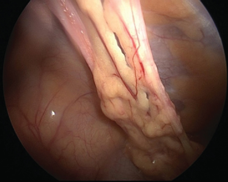 Laparoscopy showing omental adhesions.